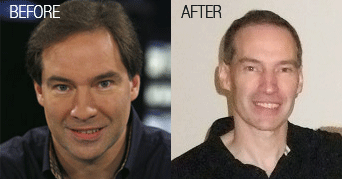 ted_forrest_before-after